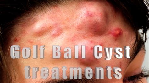 treat huge acne cysts  size  golf balls youtube