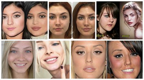 Lip Fillers And Why Is Everyone Getting Them The Fashion Tag Blog