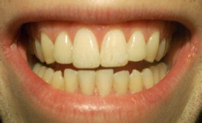 front teeth   longer    teeth
