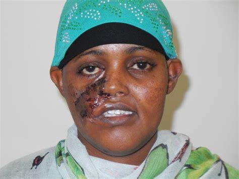 a new face for somali woman shot 25 years ago thanks to 3d printing the voice