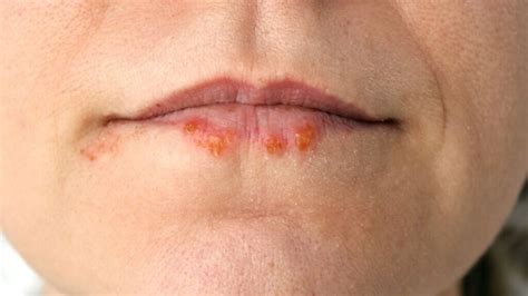 What Causes Canker Sores 1md Nutrition™