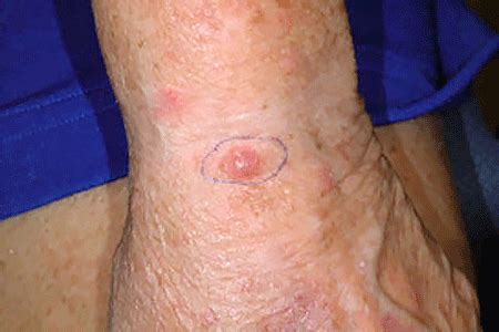 skin cancer types merkel cell carcinoma signs symptoms