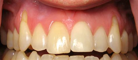 receding gums  treatment surgery  prevention sappperton