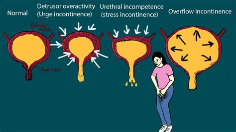 Urinary Incontinence Why Can T I Hold My Pee Causes And Treatment