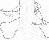 Sinus Endoscopic Surgery Functional Fess Complications Associated Include Rare Following sketch template
