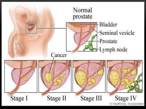 prostate cancer for public awareness by dr rubz
