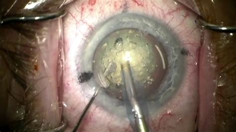 Femto Laser Assisted Cataract Surgery Youtube