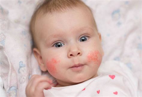 gambar bintik merah akibat alergi susu sapi  bayi