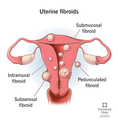 understanding fibroids  symptoms  treatments   nurse expert