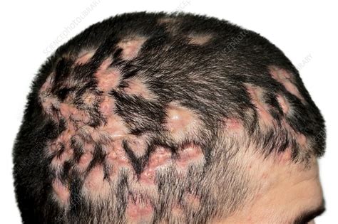 Dissecting Folliculitis On The Scalp Stock Image C011 9521