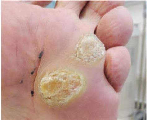 how to take care of plantar warts information