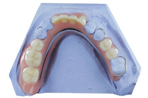 partiele prothese labo de witte partner van de tandarts