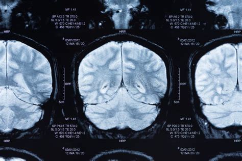 mri scan hersenen stock foto image  ziekte gezondheid