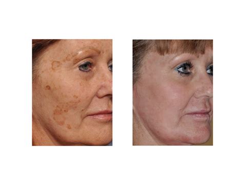 blog archivecase study laser resurfacing  facial brown spots