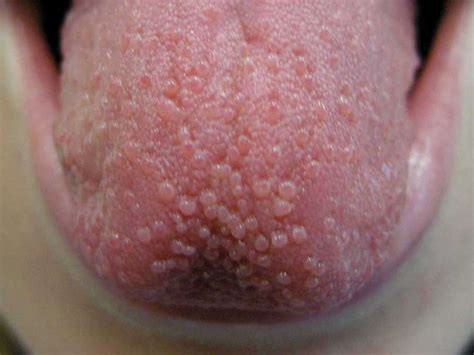 tongue bumps causes when to see a doctor and treatment