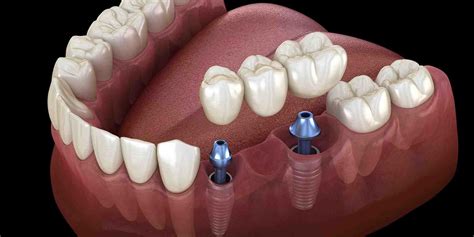dental implants   dental news network