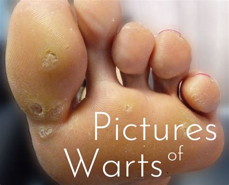 pictures  warts  types  home treatments hubpages