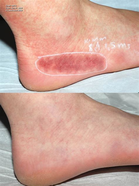Red Spots On Feet Woman Sex