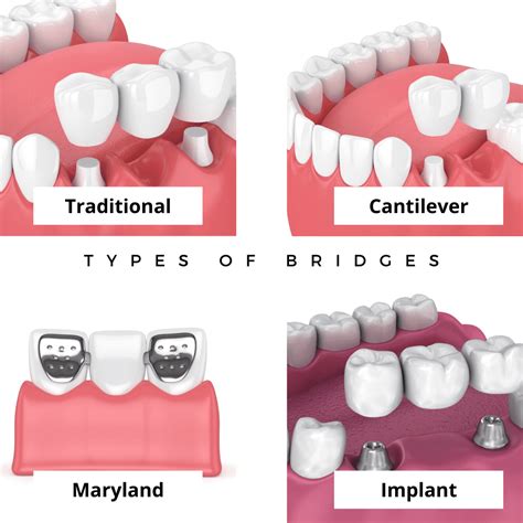 crowns  bridges treatment  dentistry  bradenton fl