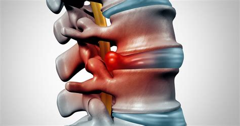 can herniated discs heal on their own