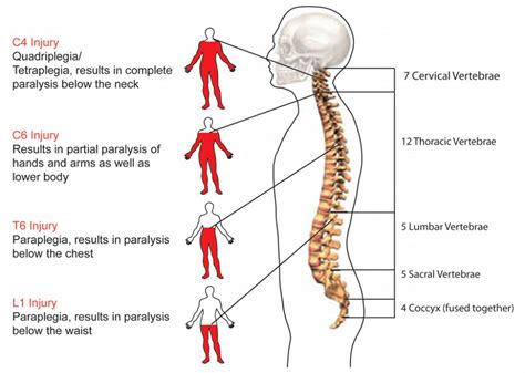 spinal cord injury mtkenyatimes