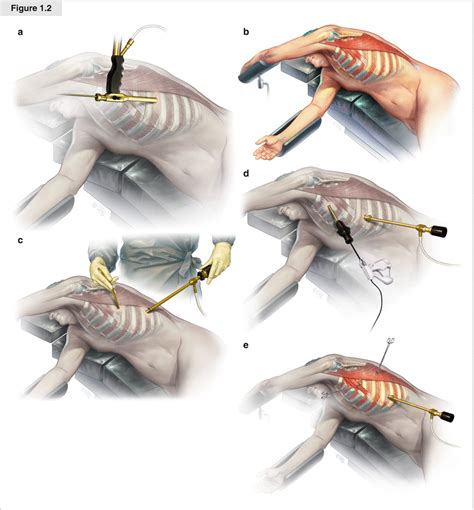video assisted thoracoscopic surgery springerlink