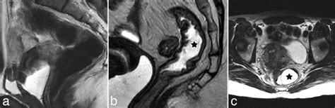sagittal t2 weighted image a with significant bowel motion and
