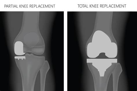 partial knee replacement  total knee replacement