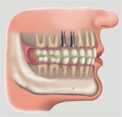 quanto custa implante dentário consulta ideal