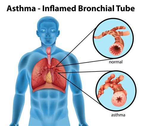 essential oils    asthma treatment essential oil benefits