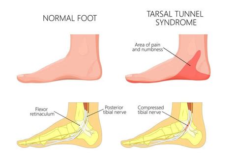 brandende voeten de voet specialist tarsaal tunnel syndroom