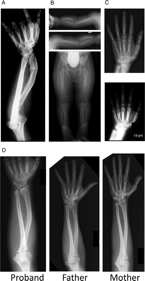 Skeletal Defects Associated With Shox Deficiency A Madelung Deformity