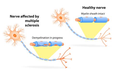 genentech multiple sclerosis