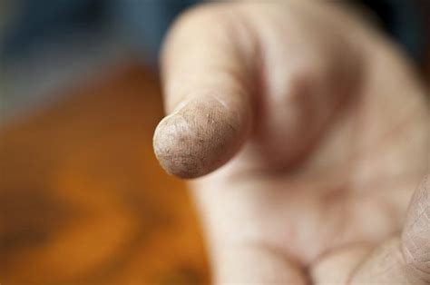Splitting Fingertips Skin Fissures Advanced Dermatology Omaha