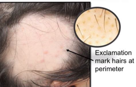 exclamation mark hairs  alopecia areata occur  perimeter  patch