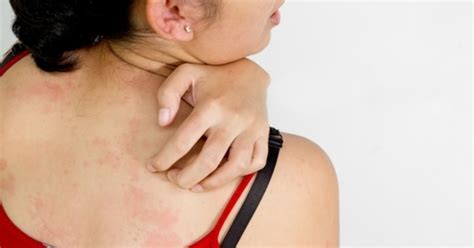 alergia en la piel sintomas causas  tratamiento tua saude