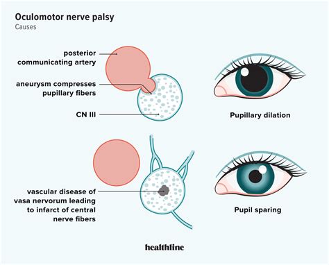 guide  oculomotor nerve palsy   treatment sexiz pix