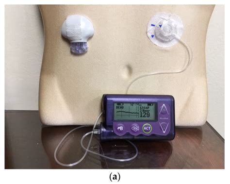 jcm free full text an overview of insulin pumps and glucose sensors