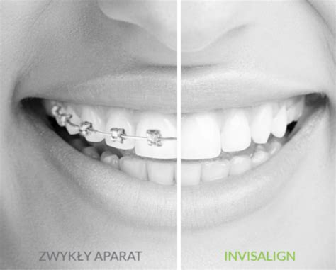 invisalign centrum stomatologiczne polident