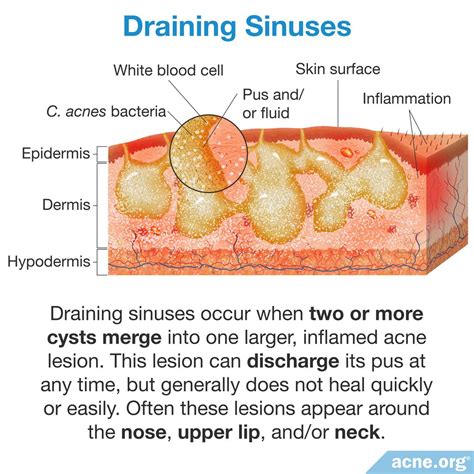 draining sinus acneorg