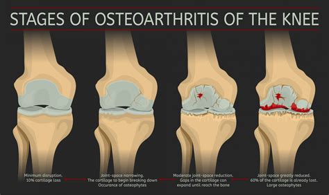 recommendations  thrive  osteoarthritis   knee