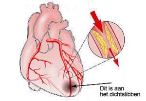 hartinfarct algemeen menselijk lichaam