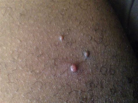 warts on the inner thigh warts on the inner thigh