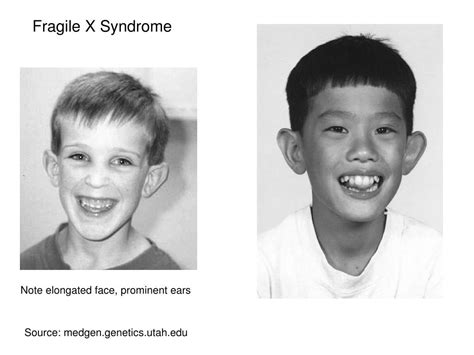 Fragile X Syndrome Causes