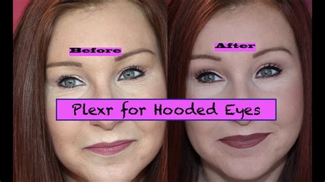 surgical treatment  hooded eyelids captions trend
