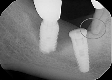 Dental Implant Complications Infection Pain Loose Implants