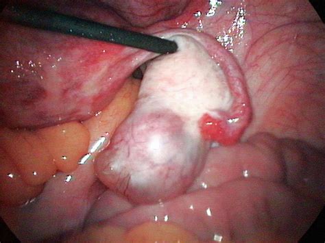 ovarian cyst photograph by dr najeeb layyous science photo library