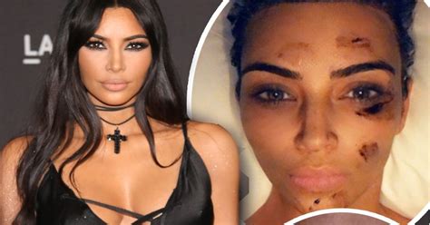 Kim Kardashian Candidly Opens Up On Painful Skin Condition As She