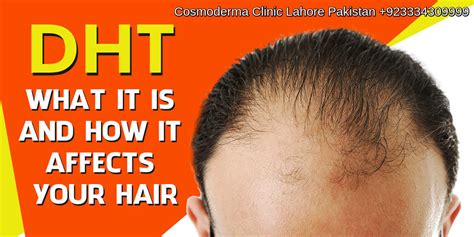 Male Pattern Baldness Male Sex Hormone Dht Cause