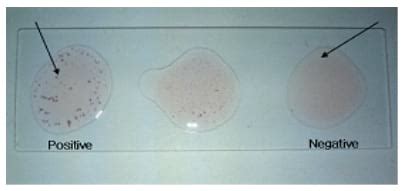 development   micro agglutination system   rapid diagnosis